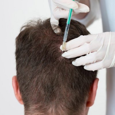 Mesoterapia Capilar.jpg