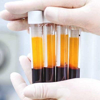 Plasma Rico em Plaquetas.jpg